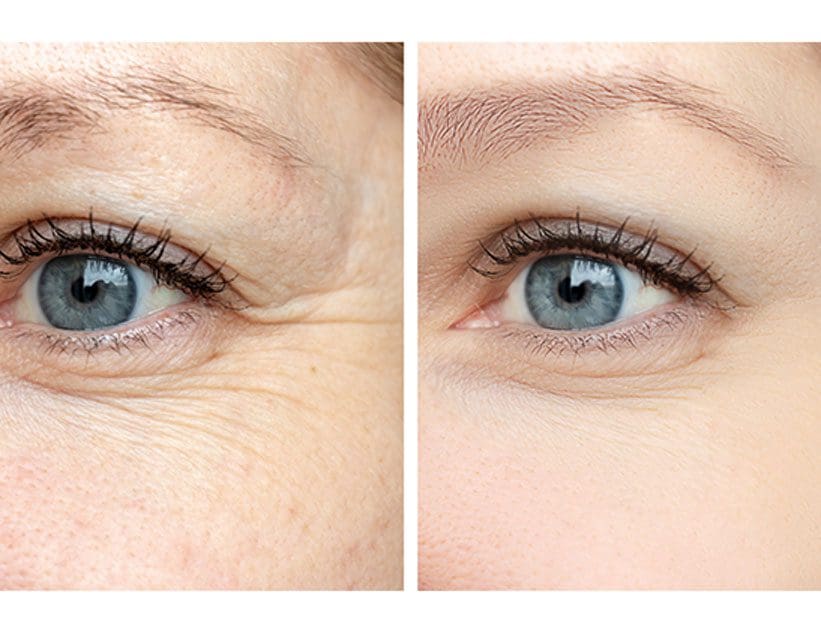 Before and after photo of a woman’s eyes after treatment