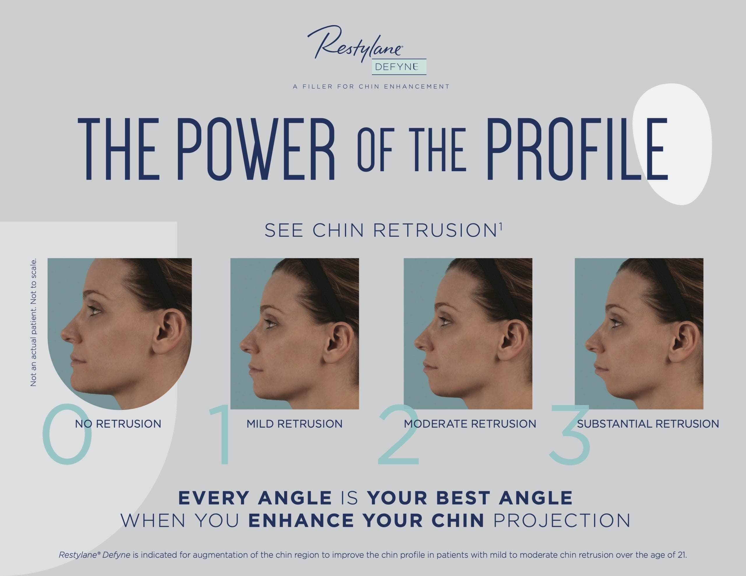 Chin-Retrusion-Scale-One-Pager