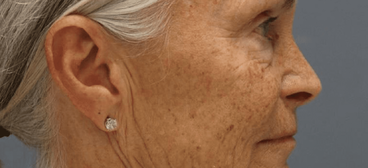 Profile of woman before and after microneedling RF-before