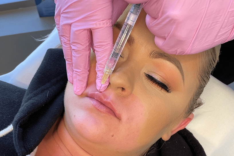 Restylane Kysse clinic photo 2