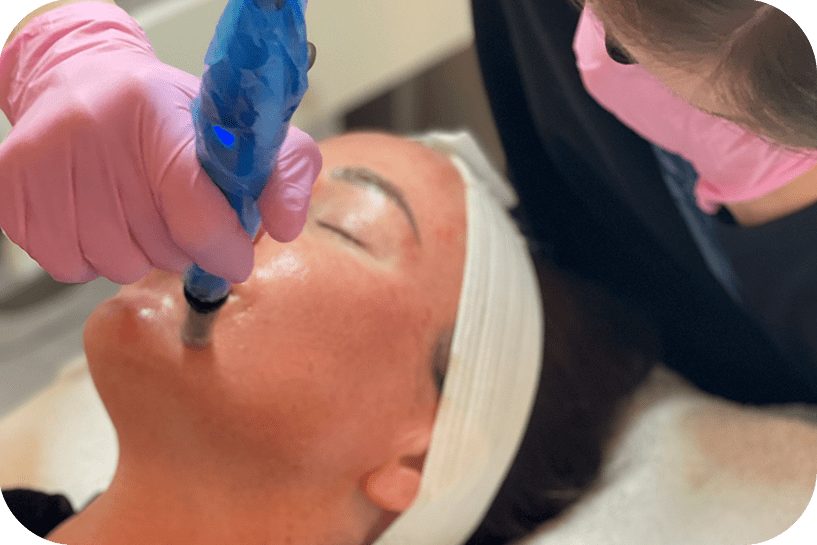 microneedling-treatment-with-the-rejuvapen-scaled