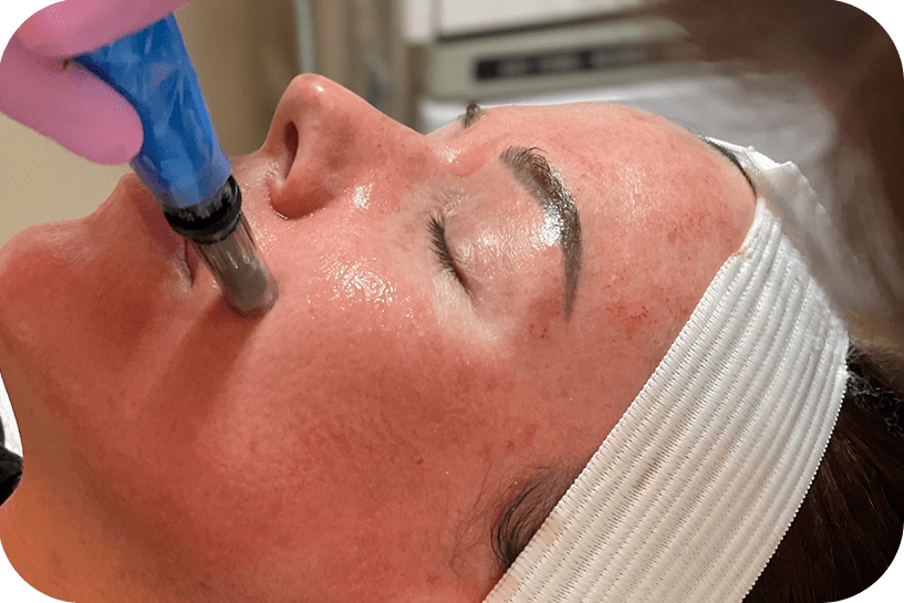 patient-receiving-microneedling-treatment-scaled