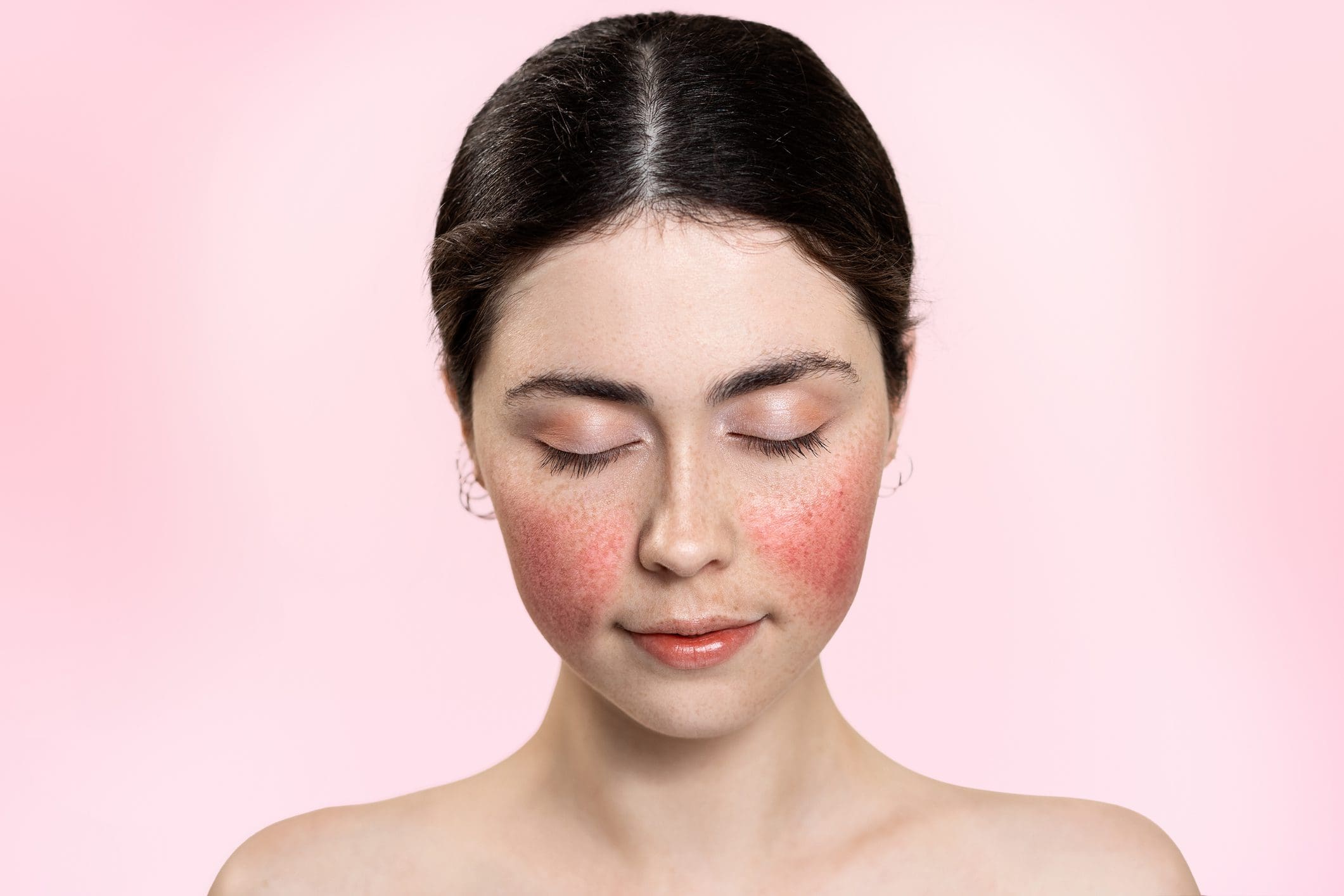 acne rosacea oily skin